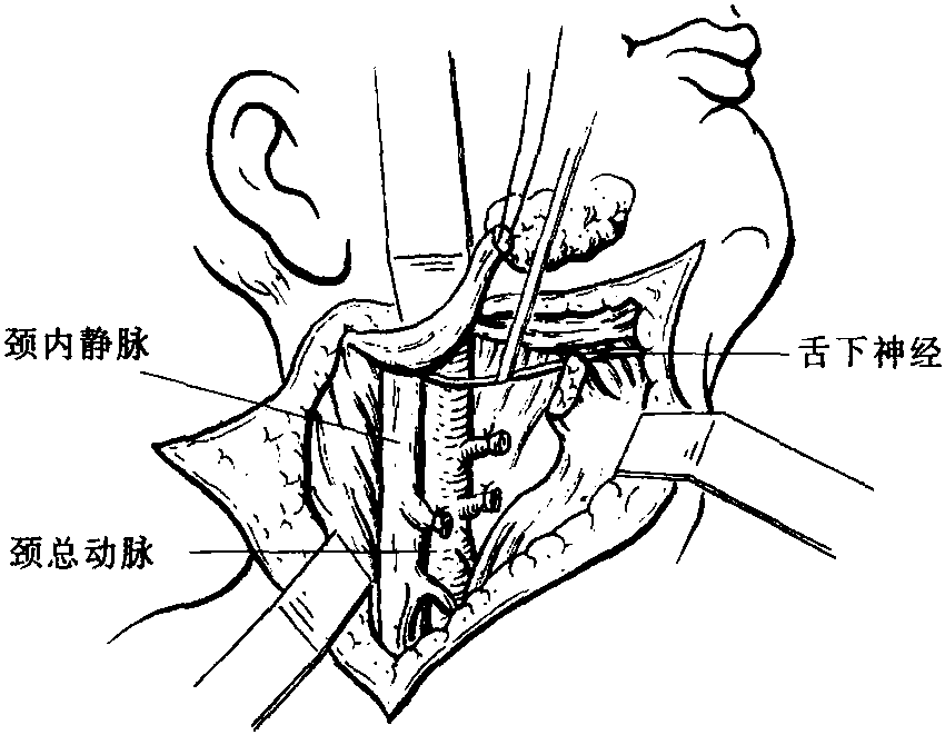 2 显露颈椎1～3的前内侧入路